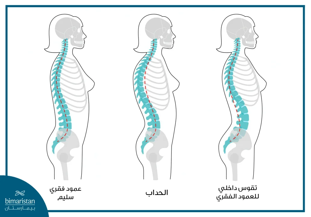 عملية رأب الفقرات بالبالون: علاج بلا جراحة 2 تشوهات في العمود الفقري أحد أسباب عملية رأب الفقرات بالبالون
