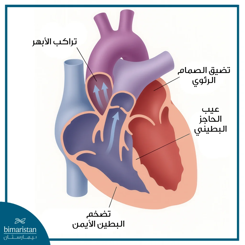 عيوب القلب الخلقية لدى الأطفال: الأعراض والأسباب وطرق العلاج الحديثة 4 أحد تشوهات القلب الخلقية (رباعي فالو)