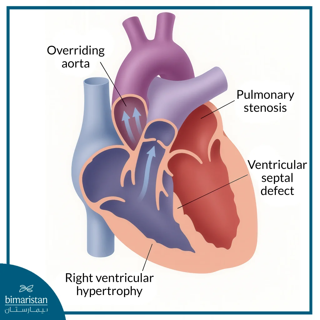Congenital Heart Defects In Children: Causes, Symptoms, And Advanced Treatment Options 4 Tetralogy Of Fallot: Congenital Heart Defect With Vsd, Pulmonary Stenosis, Overriding Aorta, And Right Ventricular Hypertrophy.