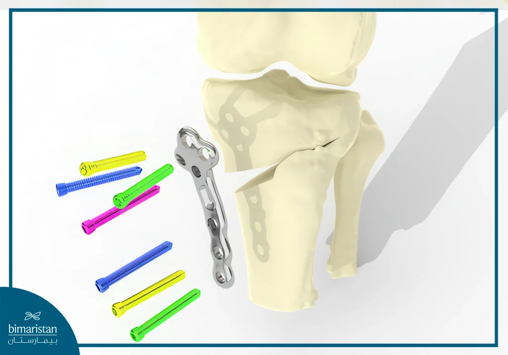 Tibial Osteotomy For Knee Osteoarthritis: An Effective Alternative To Artificial Joint Surgery 4 An Image Illustrating The General Mechanism Of Tibial Osteotomy