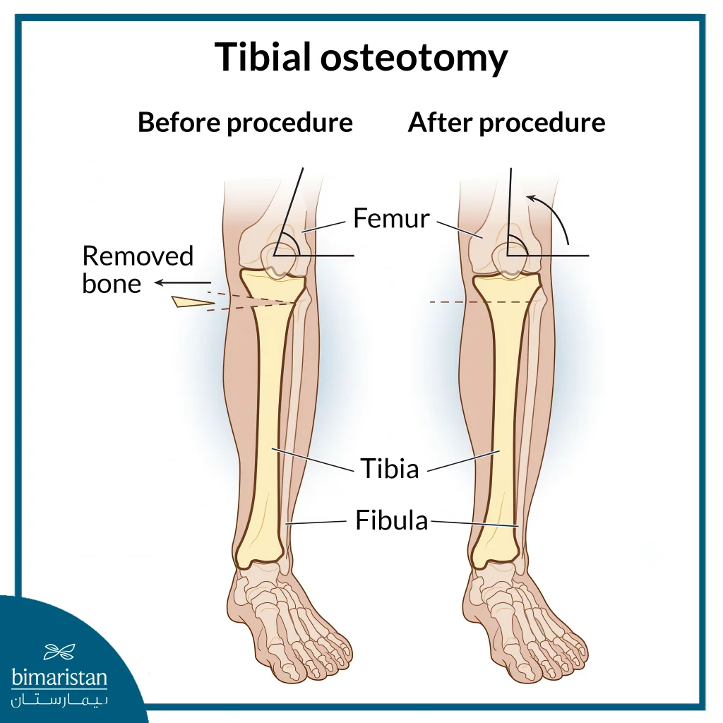 Tibial Osteotomy For Knee Osteoarthritis: An Effective Alternative To Artificial Joint Surgery 5 Tibial Osteotomy, Before And After