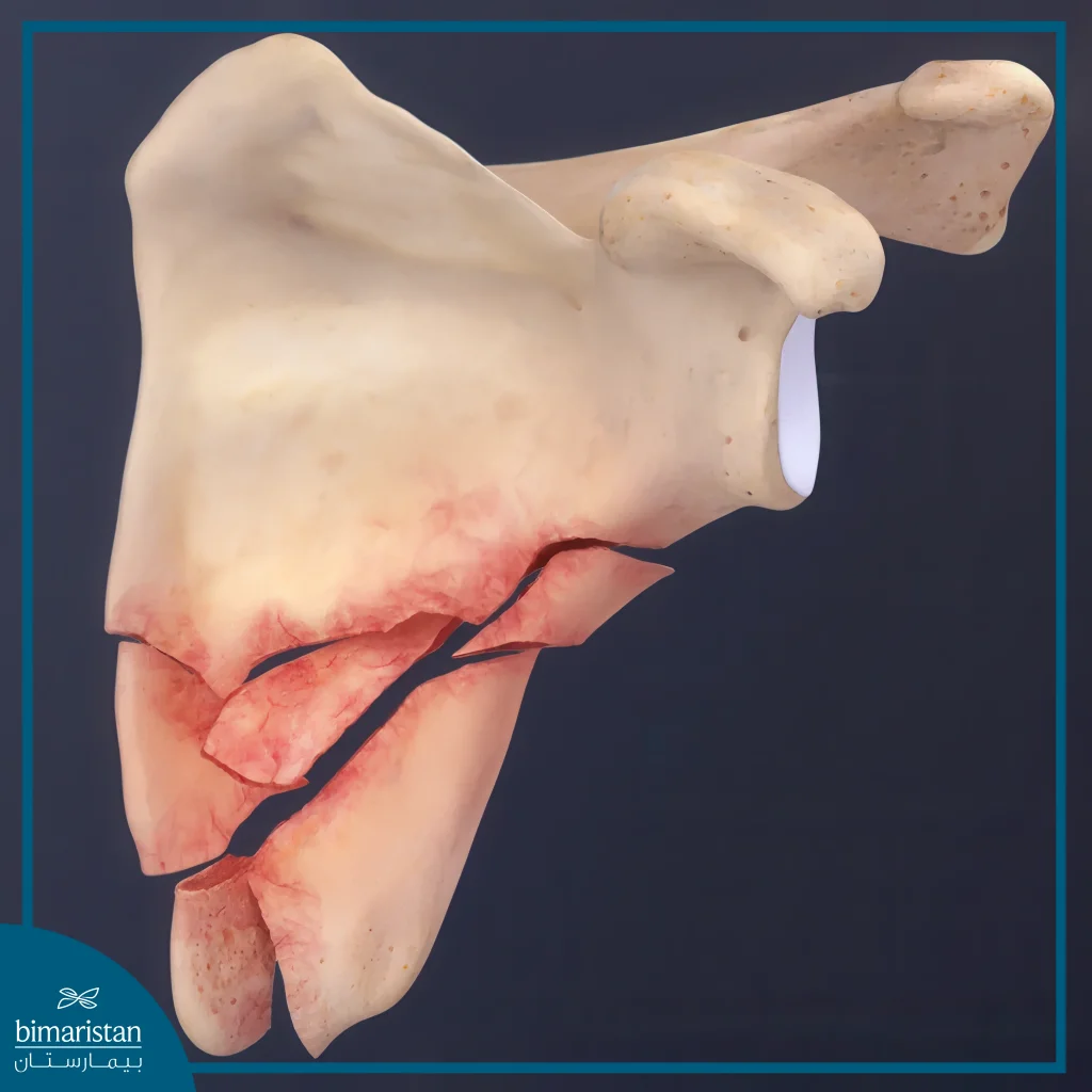 Shoulder Fracture: Symptoms, Types, And Treatment Options 6 An Illustrative Image Of A Rare Type Of Shoulder Fracture, A Fracture Of The Scapula.