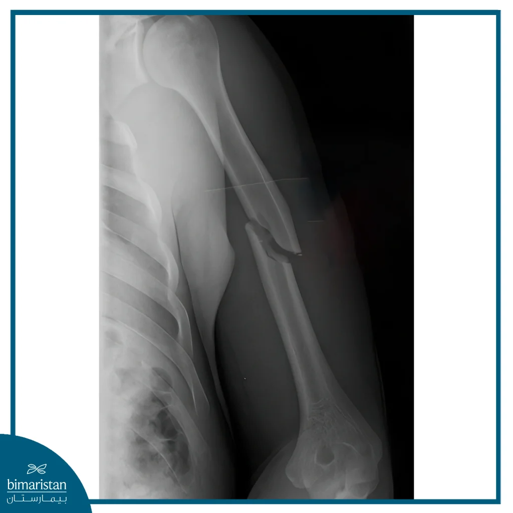 Shoulder Fracture: Symptoms, Types, And Treatment Options 5 In This Picture, We Notice A Fracture In The Middle Of The Humerus, Which Is Considered A Type Of Shoulder Fracture.