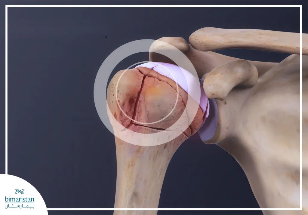 Shoulder Fracture: Symptoms, Types, And Treatment Options 4 Image Showing The Anatomy Of The Shoulder Joint With A Common Location For Fractures Of The Humerus Proximal To The Shoulder.