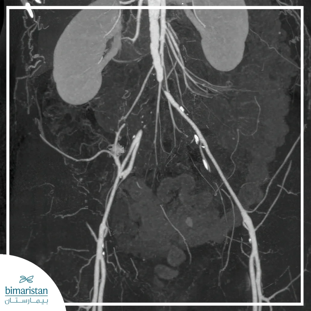 Leriche Syndrome - Lower Aortic Occlusion Treatment 3 Leriche Syndrome Was Diagnosed And An Interruption Of Blood Flow At The End Of The Aorta And The Beginning Of The Right Iliac Artery Was Detected By Contrast Angiography In Turkey.