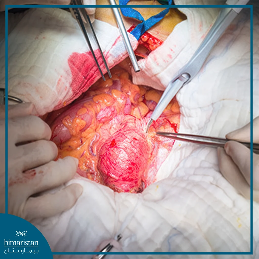 Leriche Syndrome - Lower Aortic Occlusion Treatment 4 A Photo Taken During The Surgical Treatment Of Leriche Syndrome In Turkey.