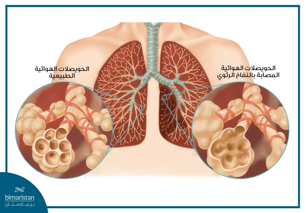 مرض الانسداد الرئوي المزمن: كيف يؤثر على التنفس؟ وهل يمكن علاجه؟ 4 الفرق بين الحويصلات الطبيعية والمصابة بالنفاخ الرئوي