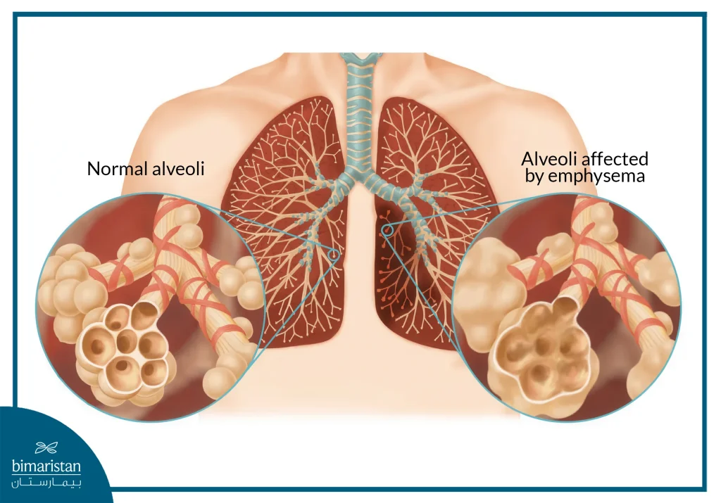 Chronic Obstructive Pulmonary Disease (Copd): How It Impacts Breathing And Treatment Options 3 The Difference Between Normal And Emphysematous Alveoli
