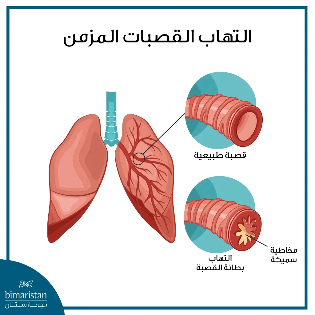 مرض الانسداد الرئوي المزمن: كيف يؤثر على التنفس؟ وهل يمكن علاجه؟ 5 الفرق ما بين القصبات الطبيعية والمصابة بالالتهاب المزمن