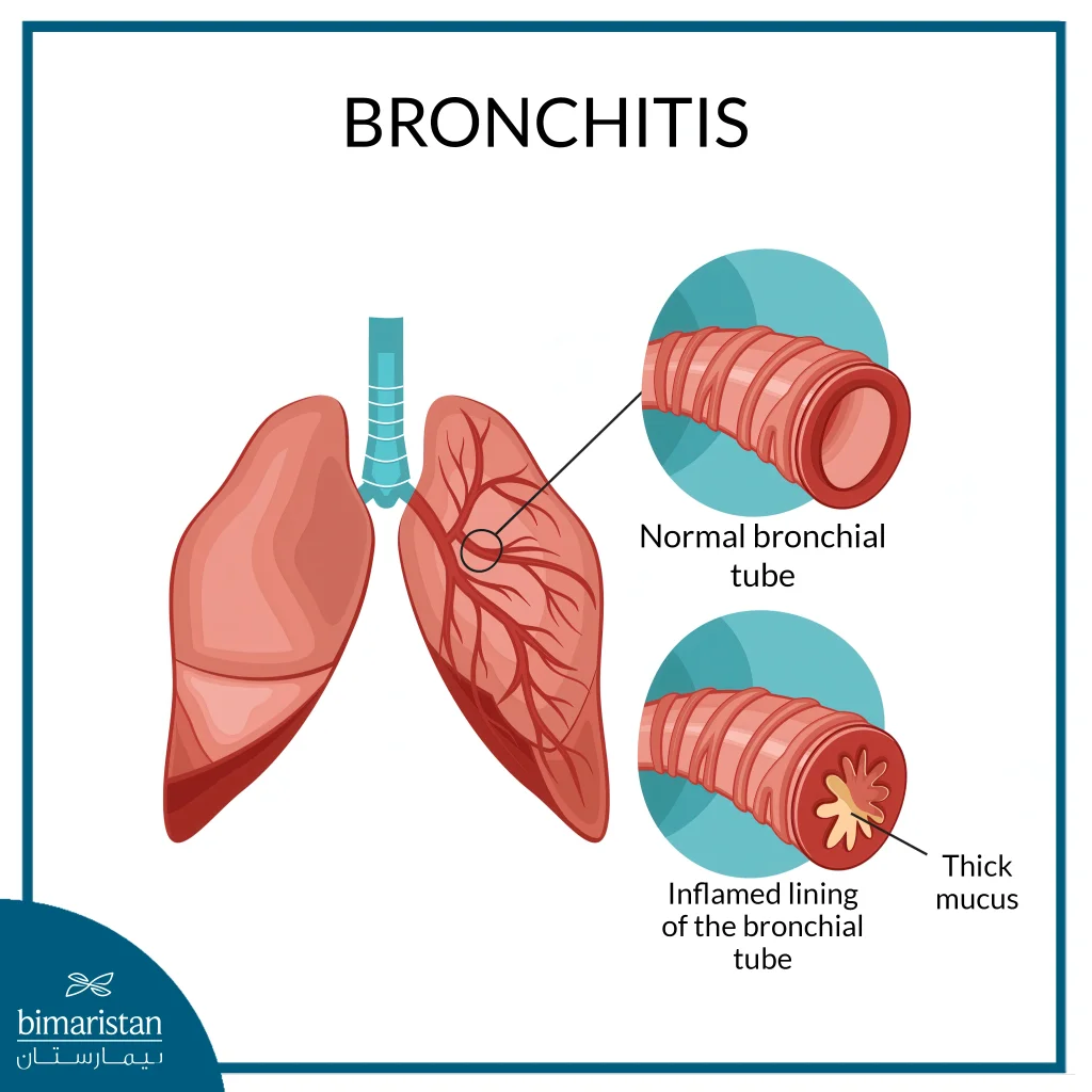 Chronic Obstructive Pulmonary Disease (Copd): How It Impacts Breathing And Treatment Options 4 The Difference Between Normal And Chronically Inflamed Bronchi