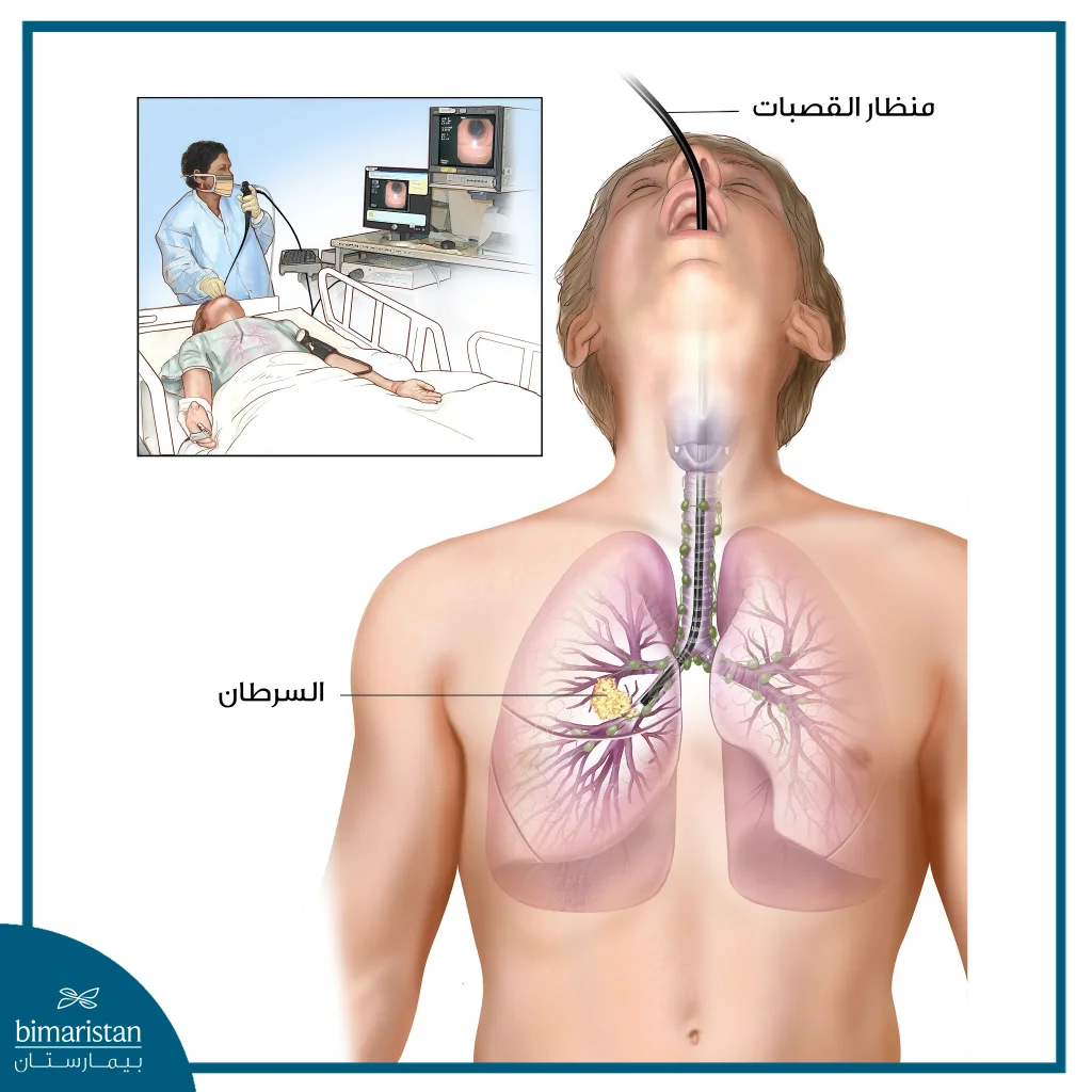 تنظير الشعب الهوائية (منظار القصبات) 6 كيفية إجراء تنظير الشعب الهوائية والذي يتم عبر إدخال المنظار المخصص بالفم ومنه إلى الطرق الهوائية الأبعد