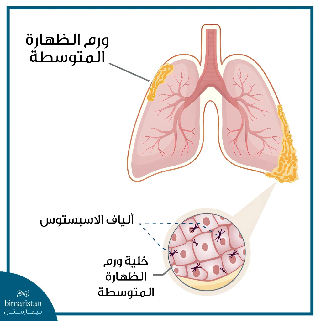 علاج ورم الظهارة المتوسطة 4 توضع ورم الظهارة المتوسطة وكيف يظهر على المستوى الخلوي