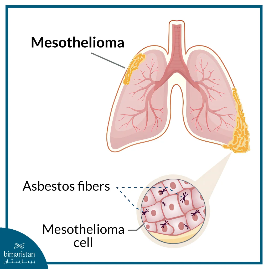 Mesothelioma Treatment 3 Mesothelioma Location And How It Appears At The Cellular Level