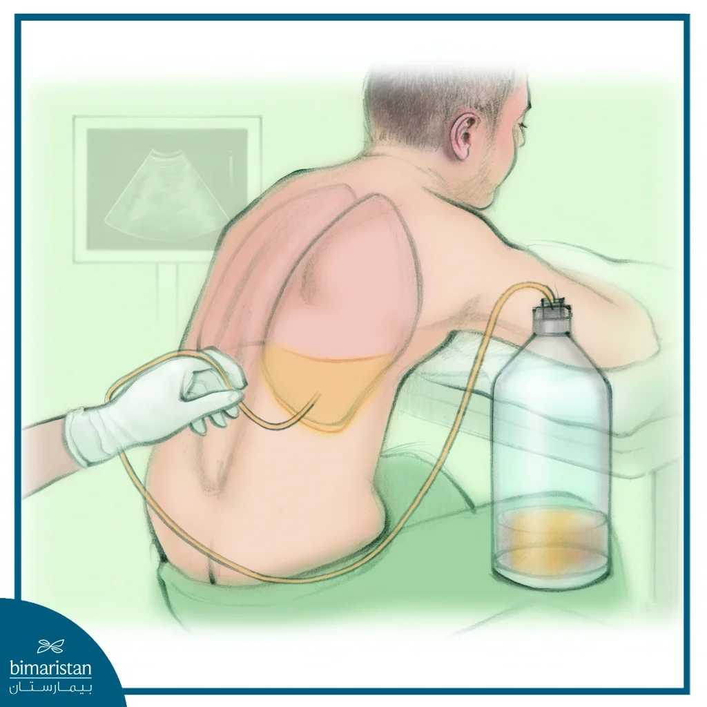 Mesothelioma Treatment 5 Illustration Of How A Thoracentesis Is Performed To Drain Fluid In Cases Of Mesothelioma.