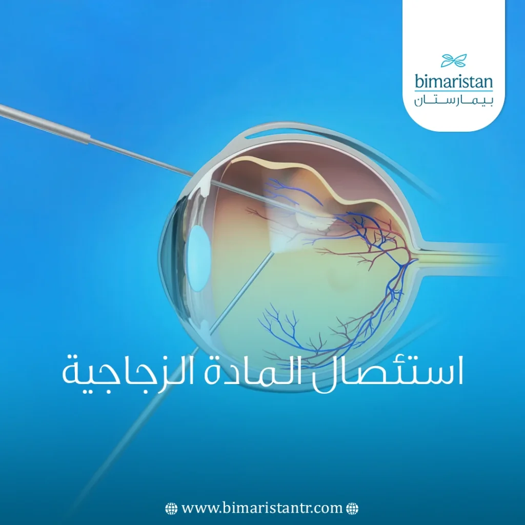 استئصال المادة الزجاجية