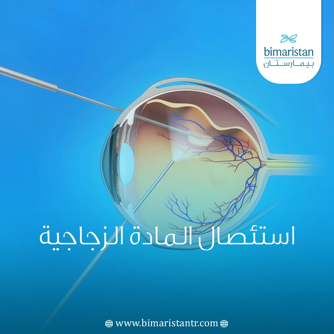 استئصال المادة الزجاجية