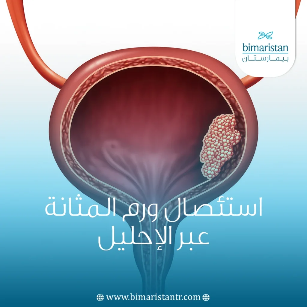 استئصال ورم المثانة عبر الإحليل