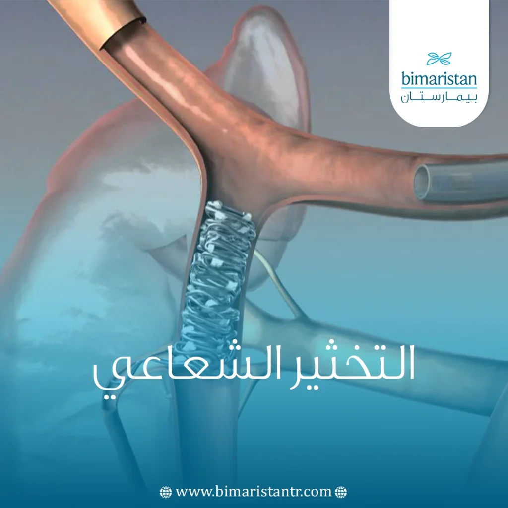 عملية التخثير (الإصمام) الشعاعي Radioembolization في تركيا