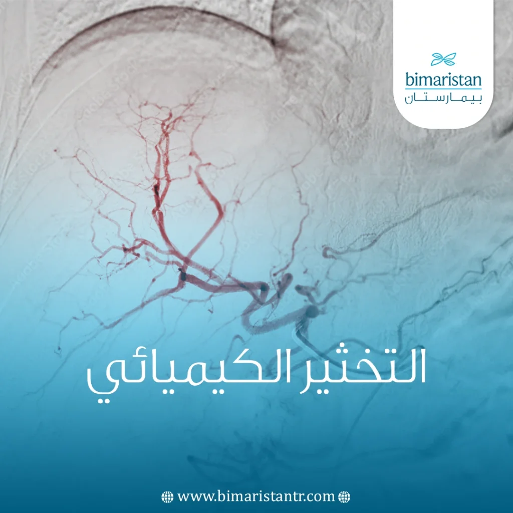 كل ما تود معرفته حول التخثير الكيميائي Chemoembolization