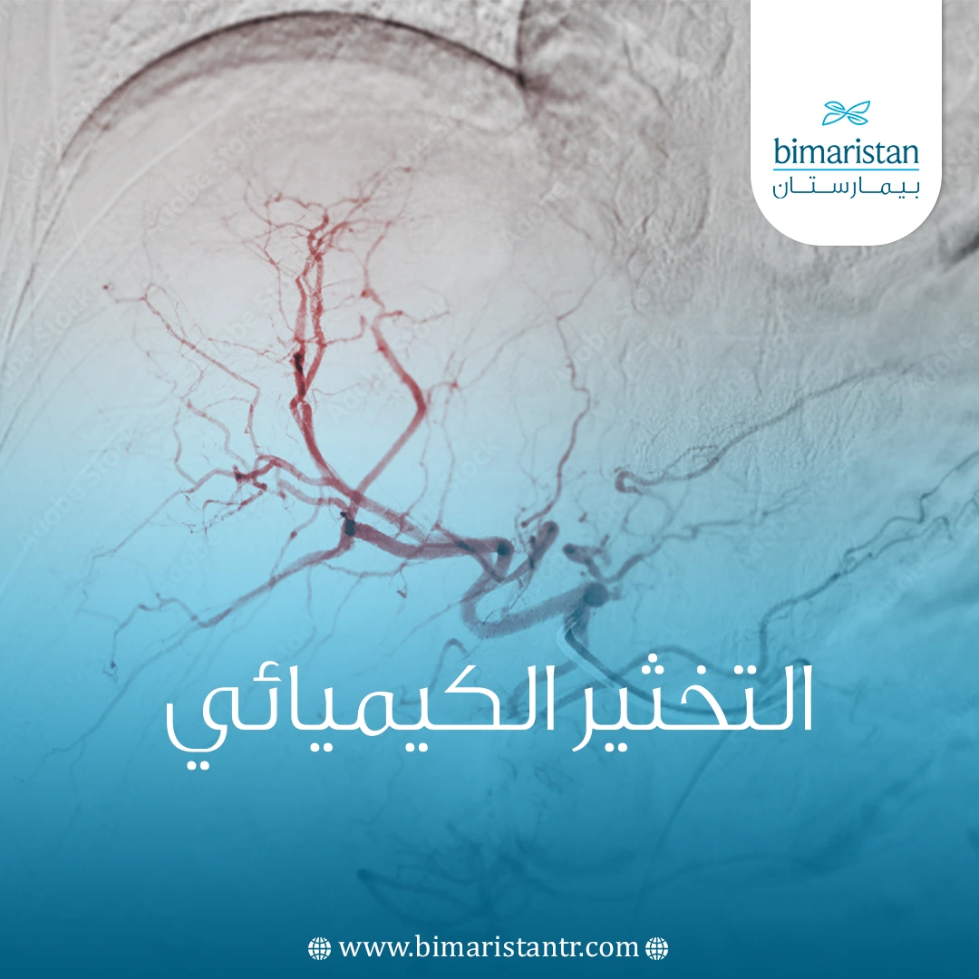 كل ما تود معرفته حول التخثير الكيميائي Chemoembolization