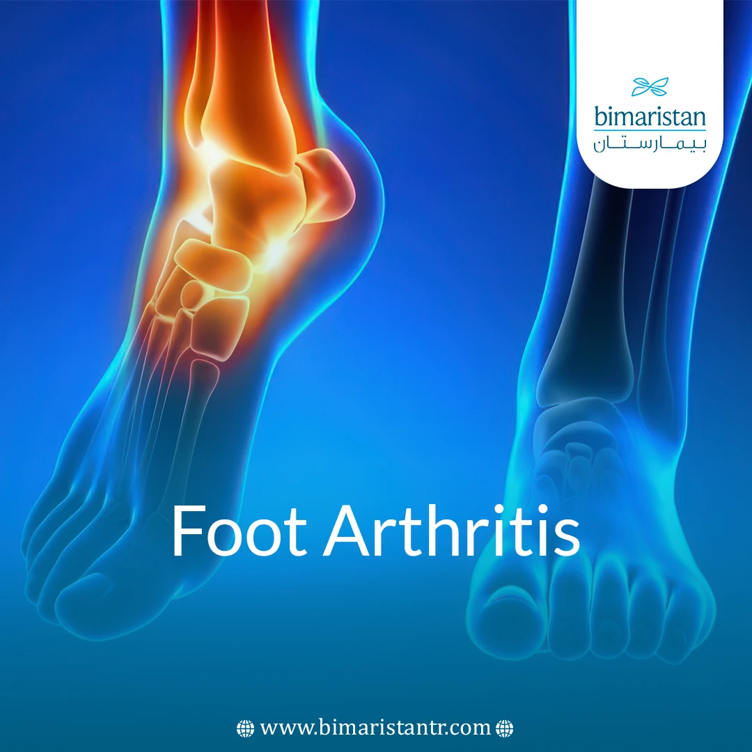 Foot Arthritis