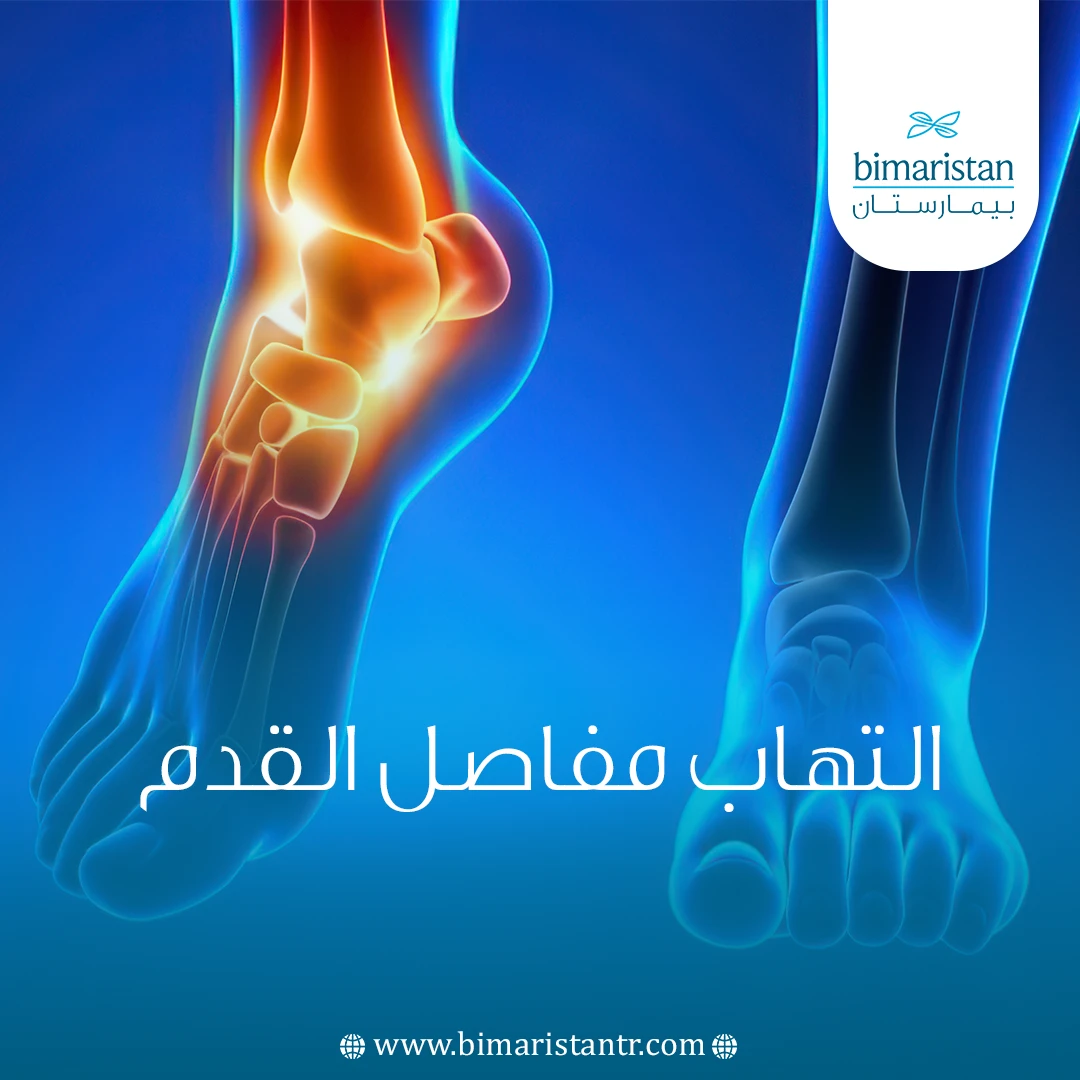 التهاب مفاصل القدم