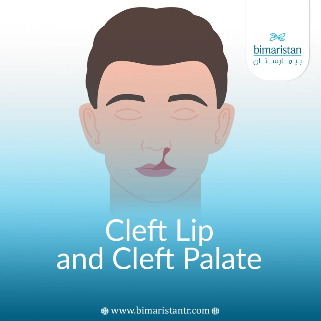 Cleft Lip And Cleft Palate: Causes &Amp; Treatments In Turkey
