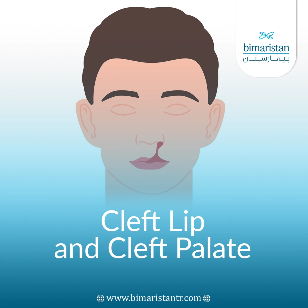 Cleft Lip And Cleft Palate: Causes &Amp;Amp; Treatments In Turkey