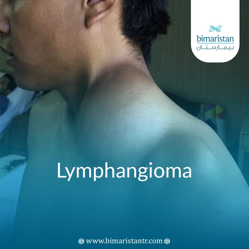 Lymphangioma Treatment In Turkey: Causes And Symptoms