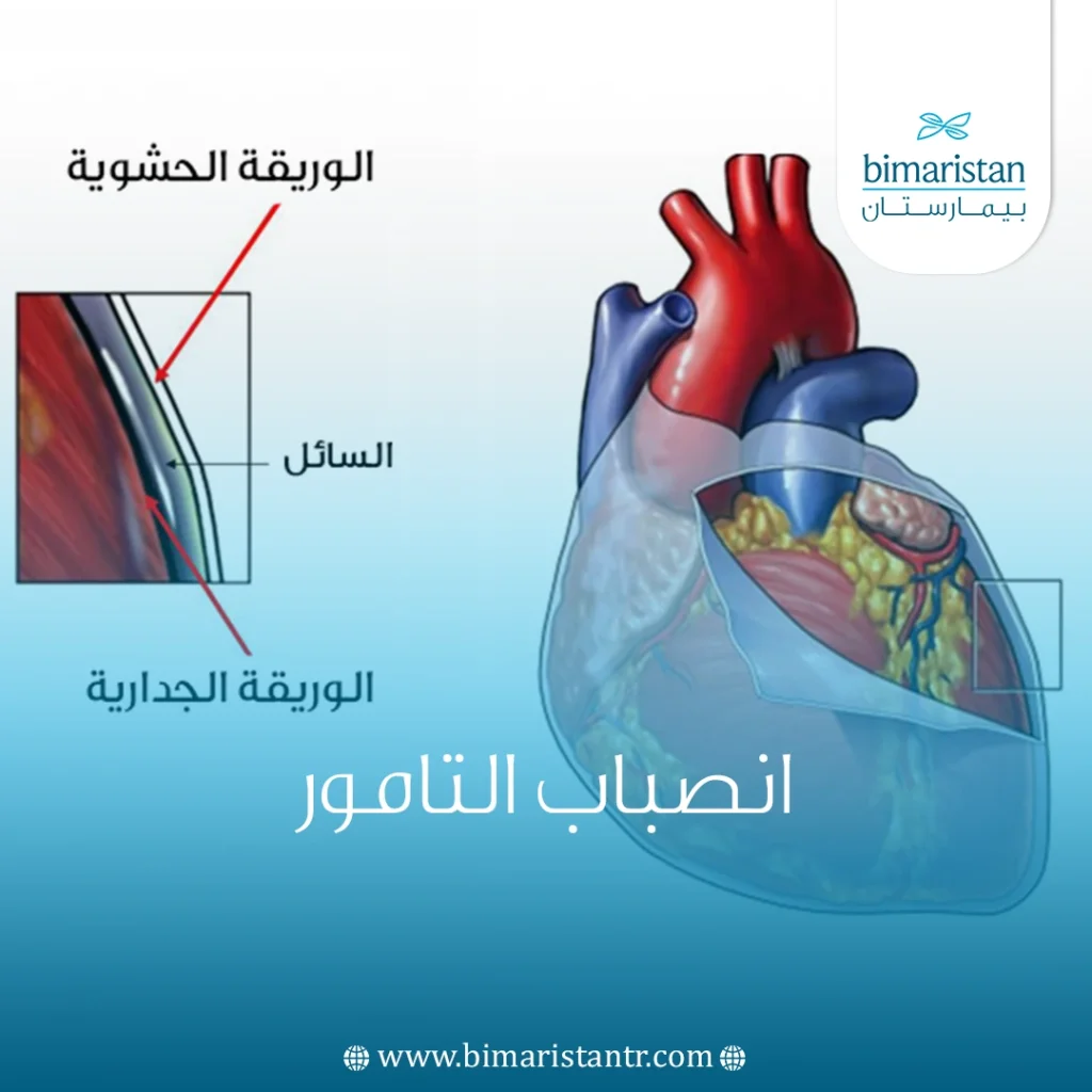 انصباب التامور: الأسباب وطرق العلاج في تركيا