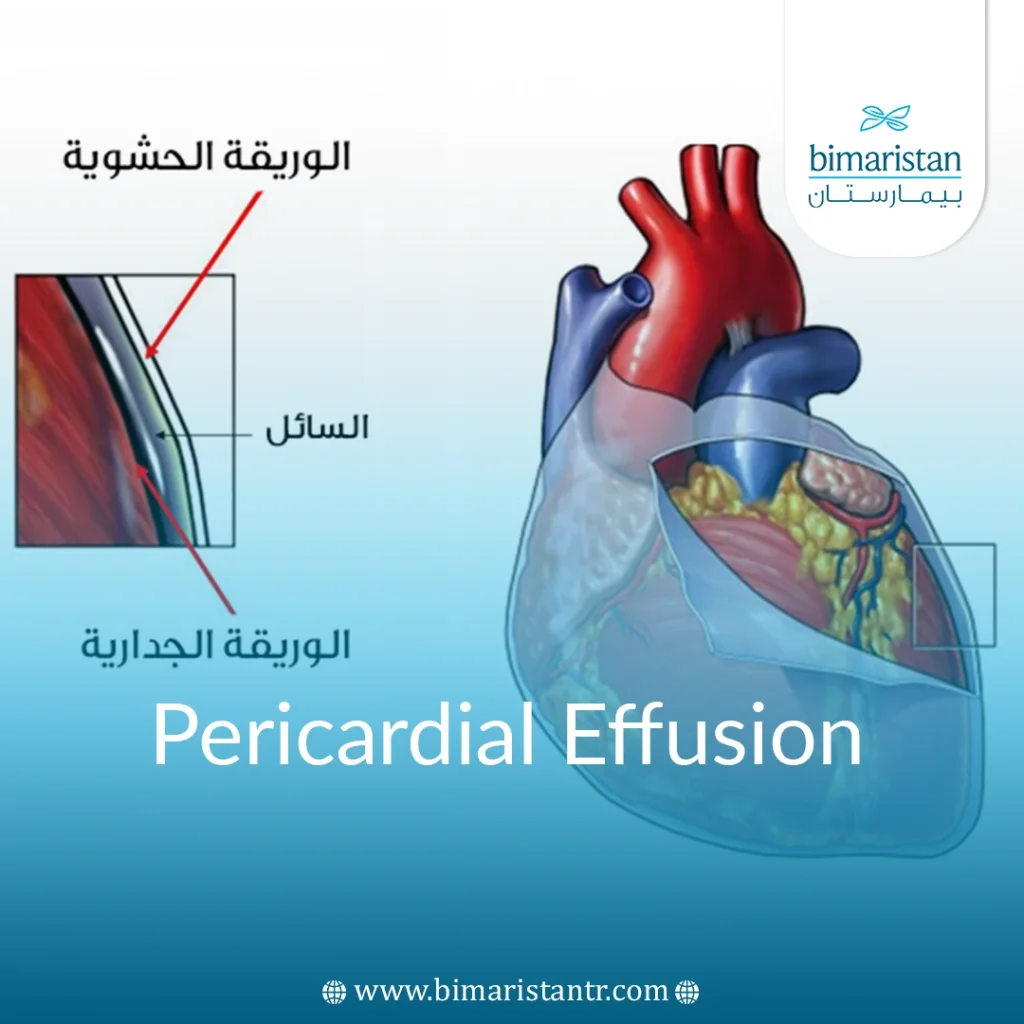 Pericardial Effusion In Turkey: Causes &Amp; Treatment Guide