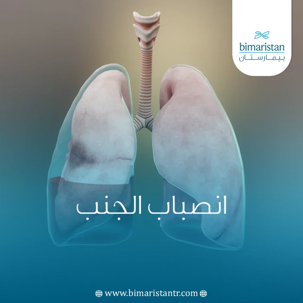 أنواع الانصباب الجنبي وطريقة علاجه