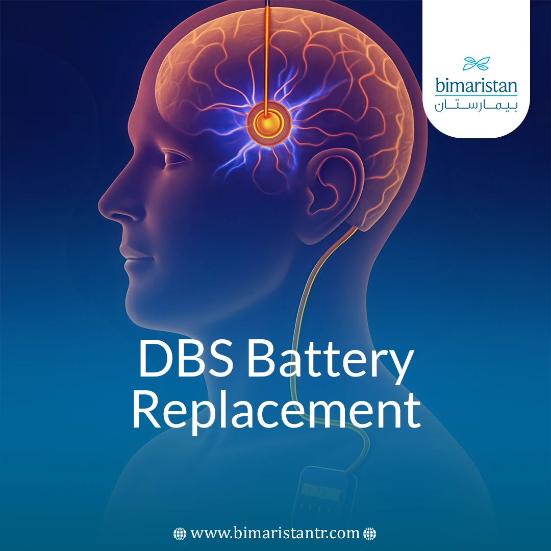 Dbs Battery Replacement: Why And When Parkinson’s Need It