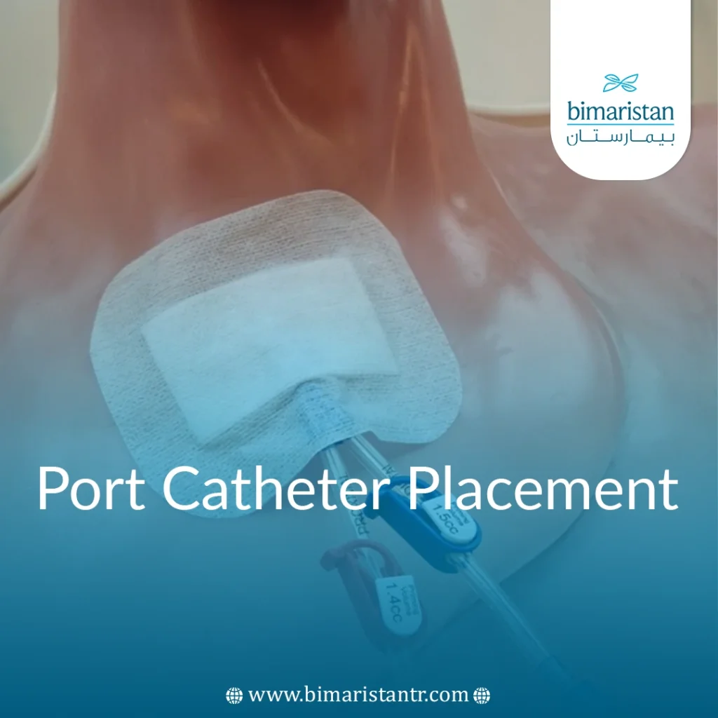 Port Catheter Placement: Central Venous Access In Turkey