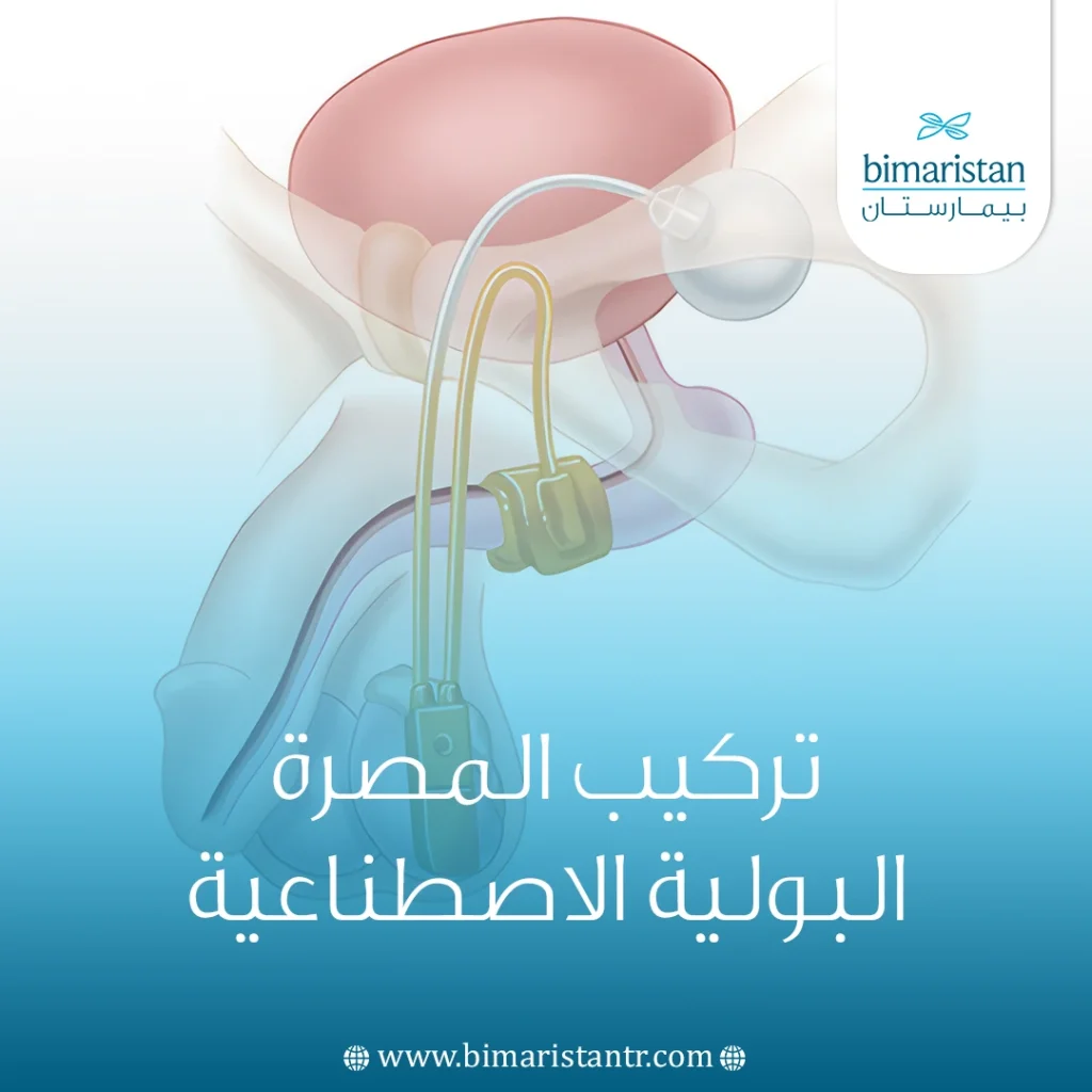 تركيب المصرة البولية الاصطناعية