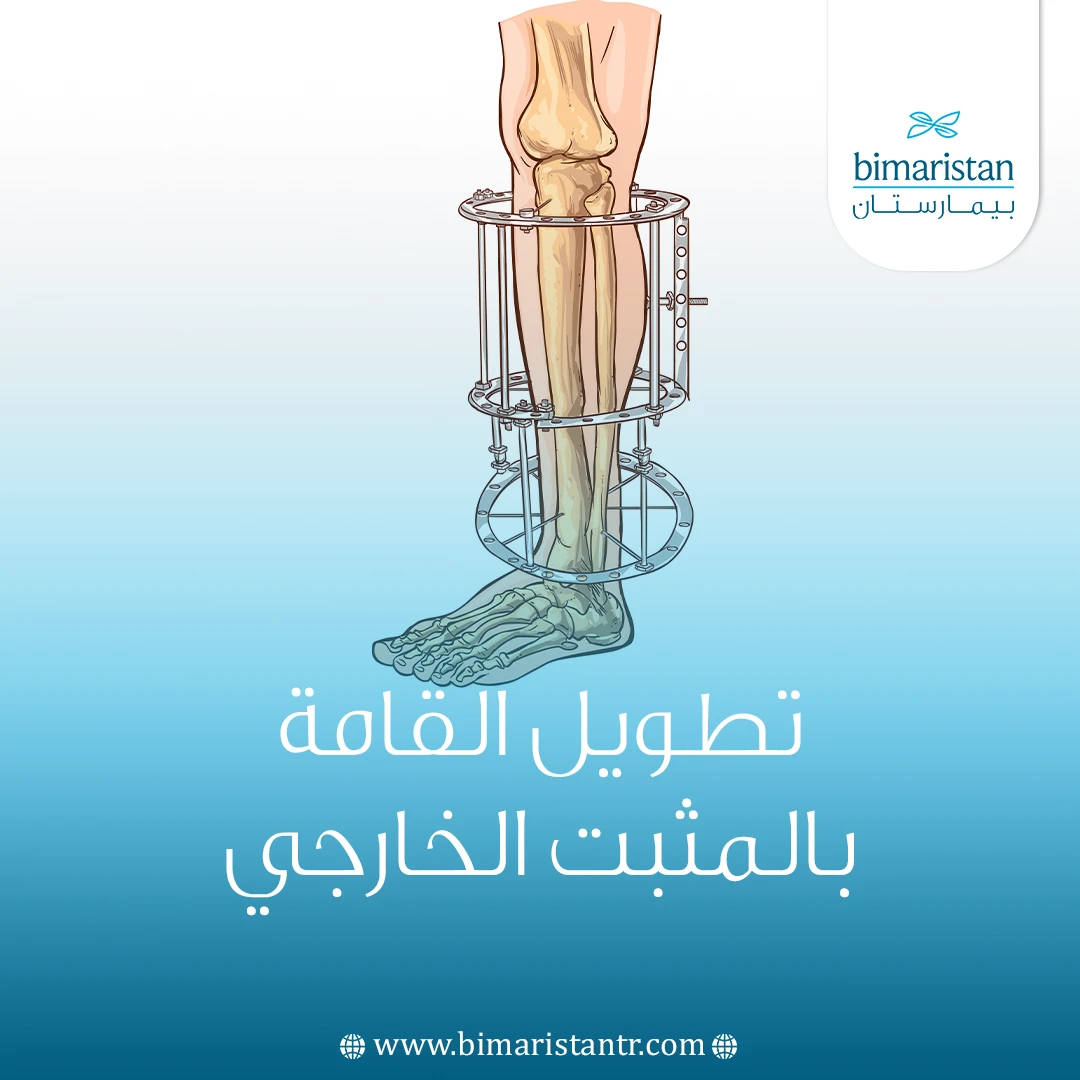 تطويل القامة بالمثبت الخارجي