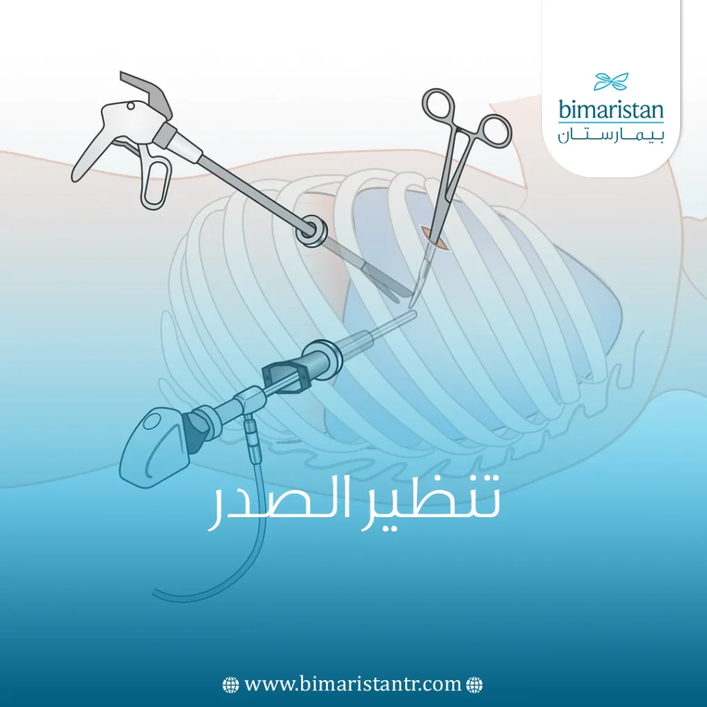 عملية تنظير الصدر في تركيا