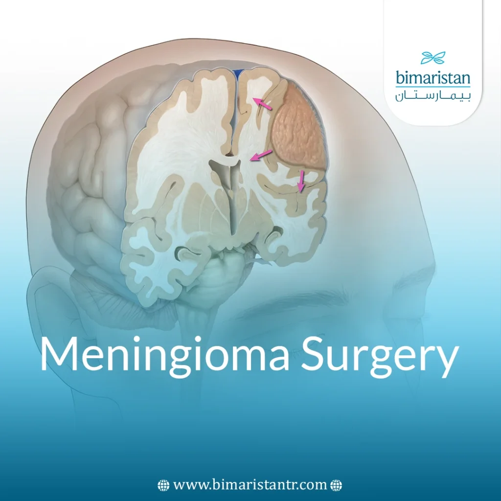 Meningioma Surgery: When Needed &Amp; Chances Of Recovery
