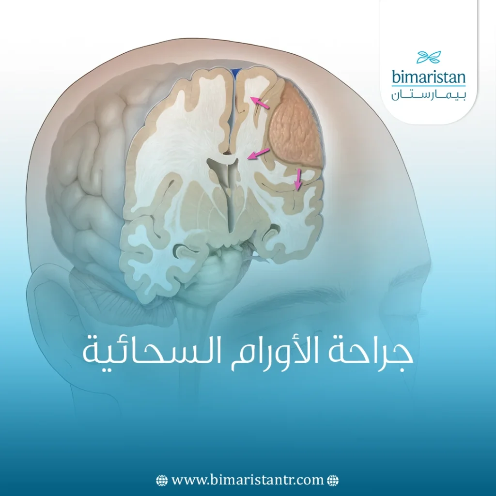 جراحة الأورام السحائية