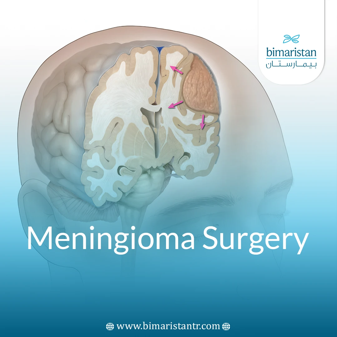 Meningioma Surgery: When Needed &Amp;Amp; Chances Of Recovery
