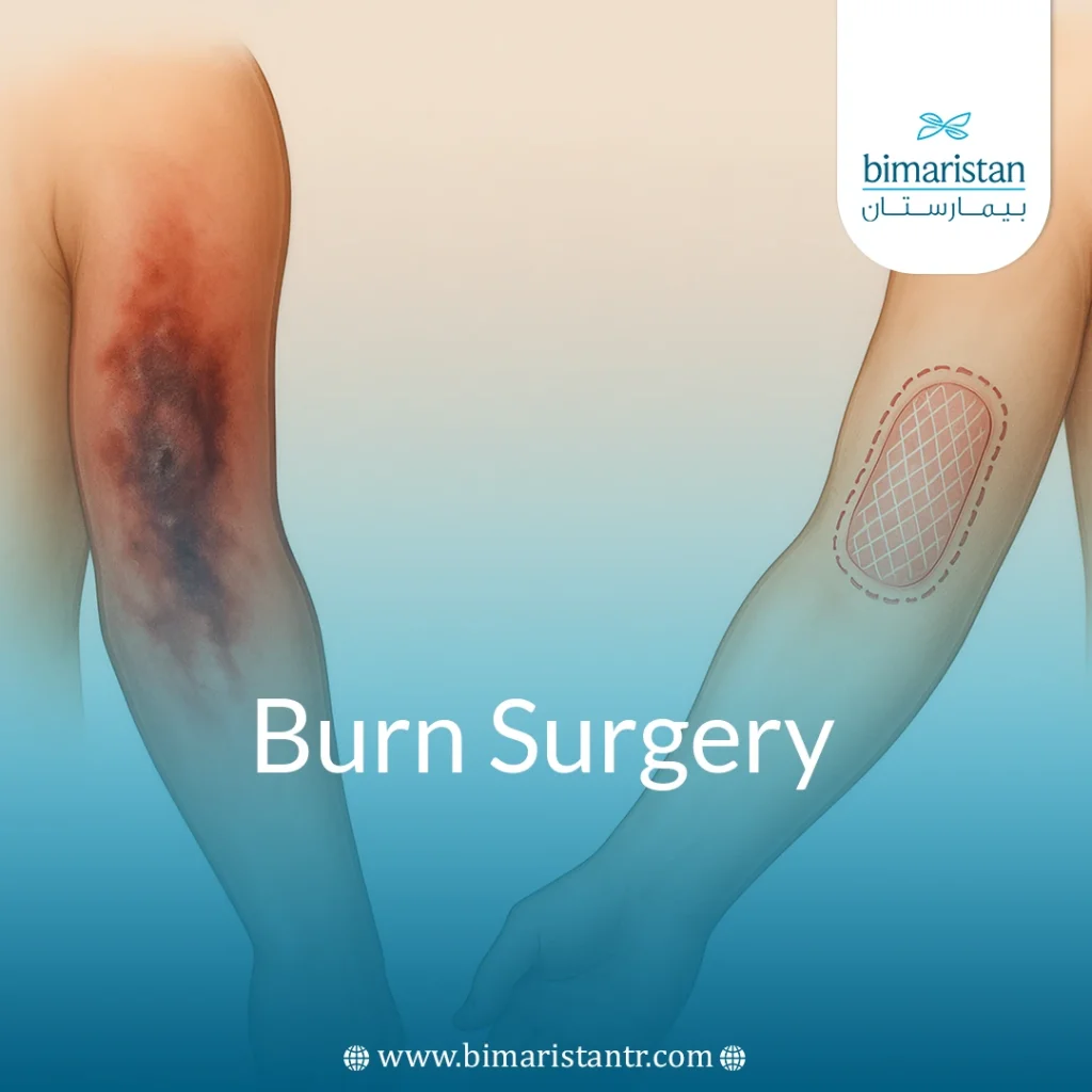 Burn Surgery