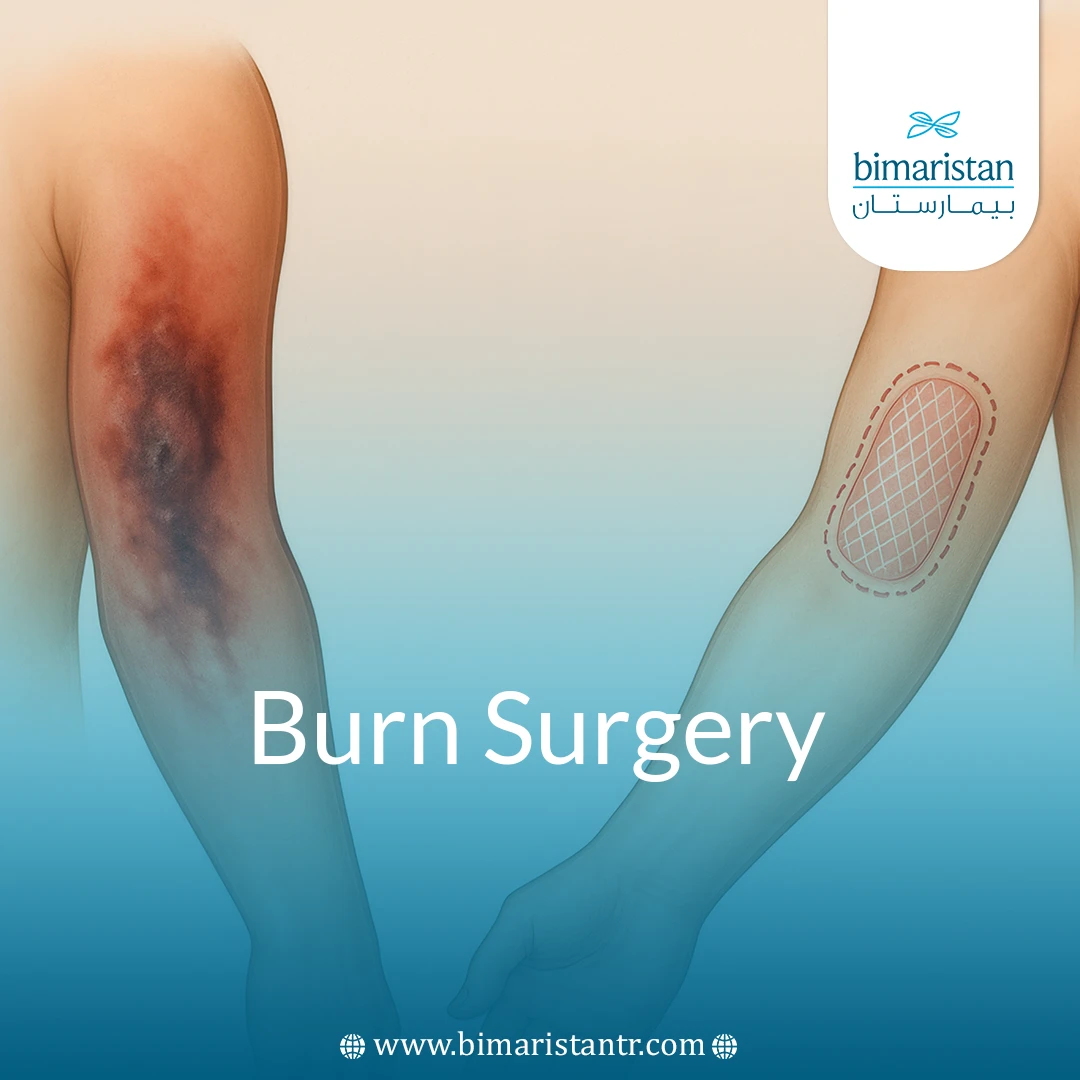 Burn Surgery