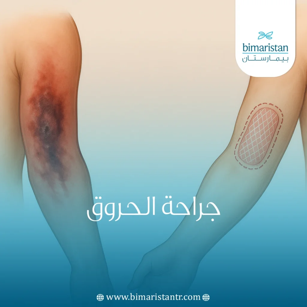 جراحة الحروق