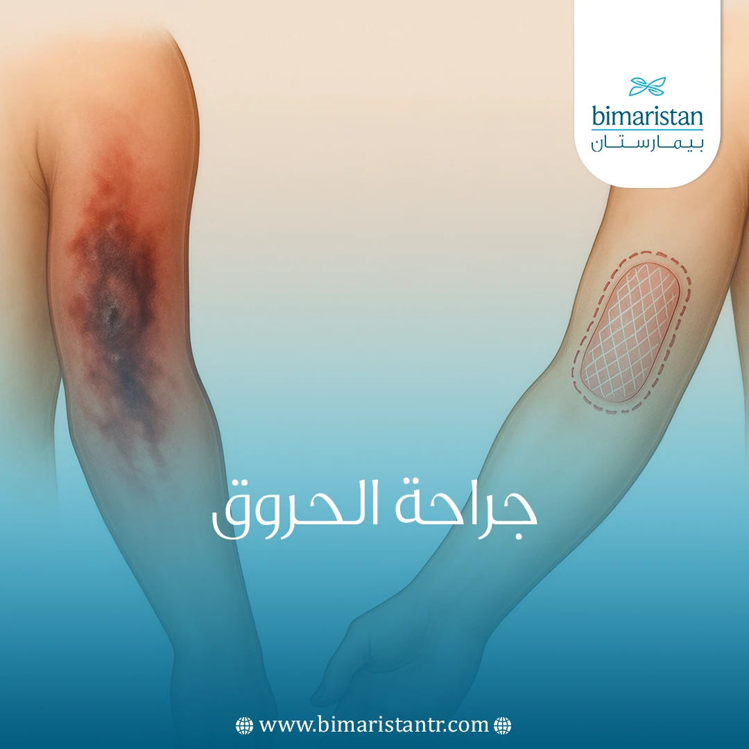 جراحة الحروق