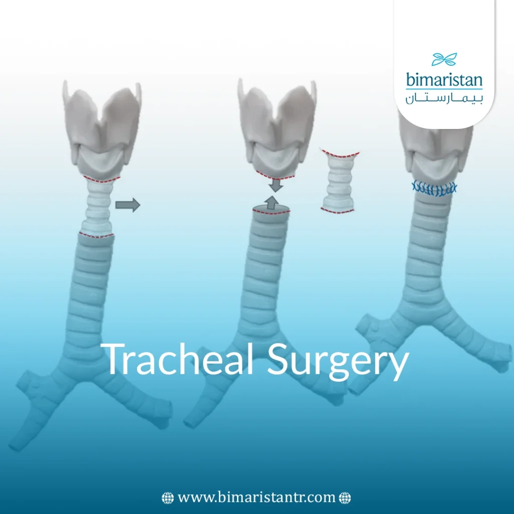 Tracheal Surgery In Turkey: Procedures, Risks &Amp; Recovery