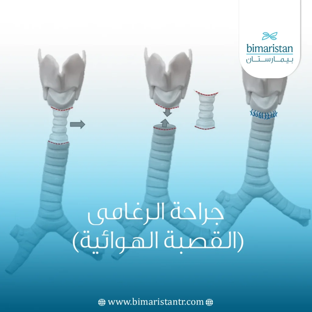 جراحة الرغامى (القصبة الهوائية) في تركيا