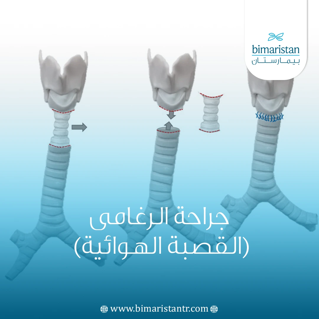 جراحة الرغامى (القصبة الهوائية) في تركيا
