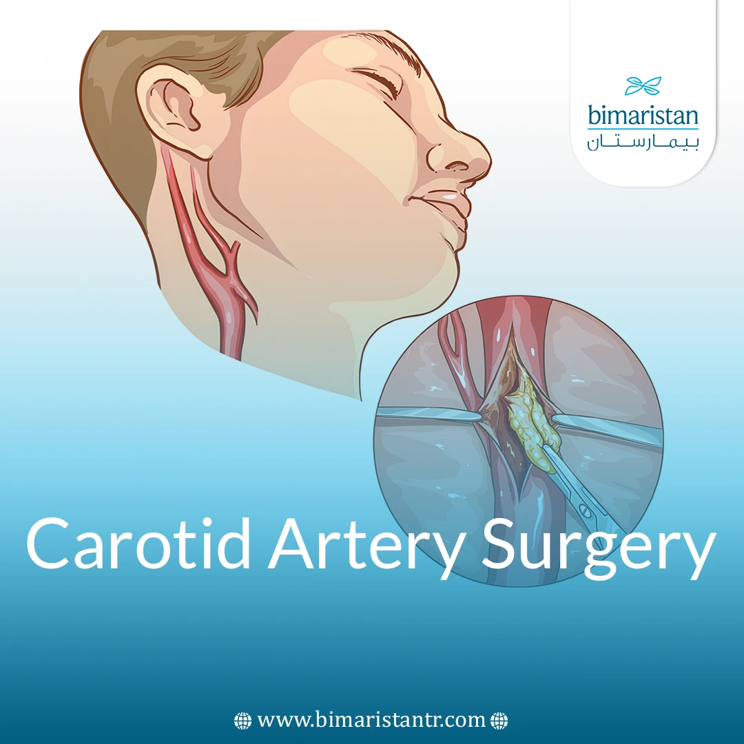 Carotid Artery Surgery: When Can It Prevent A Stroke?