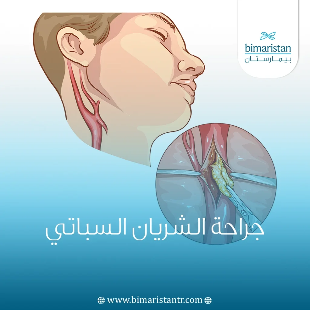 جراحة الشريان السباتي