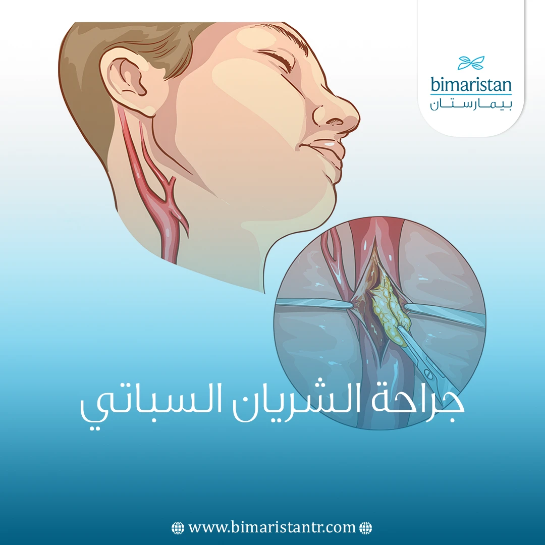 جراحة الشريان السباتي
